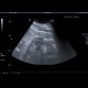 Edema of perinephric fat: US - Ultrasound